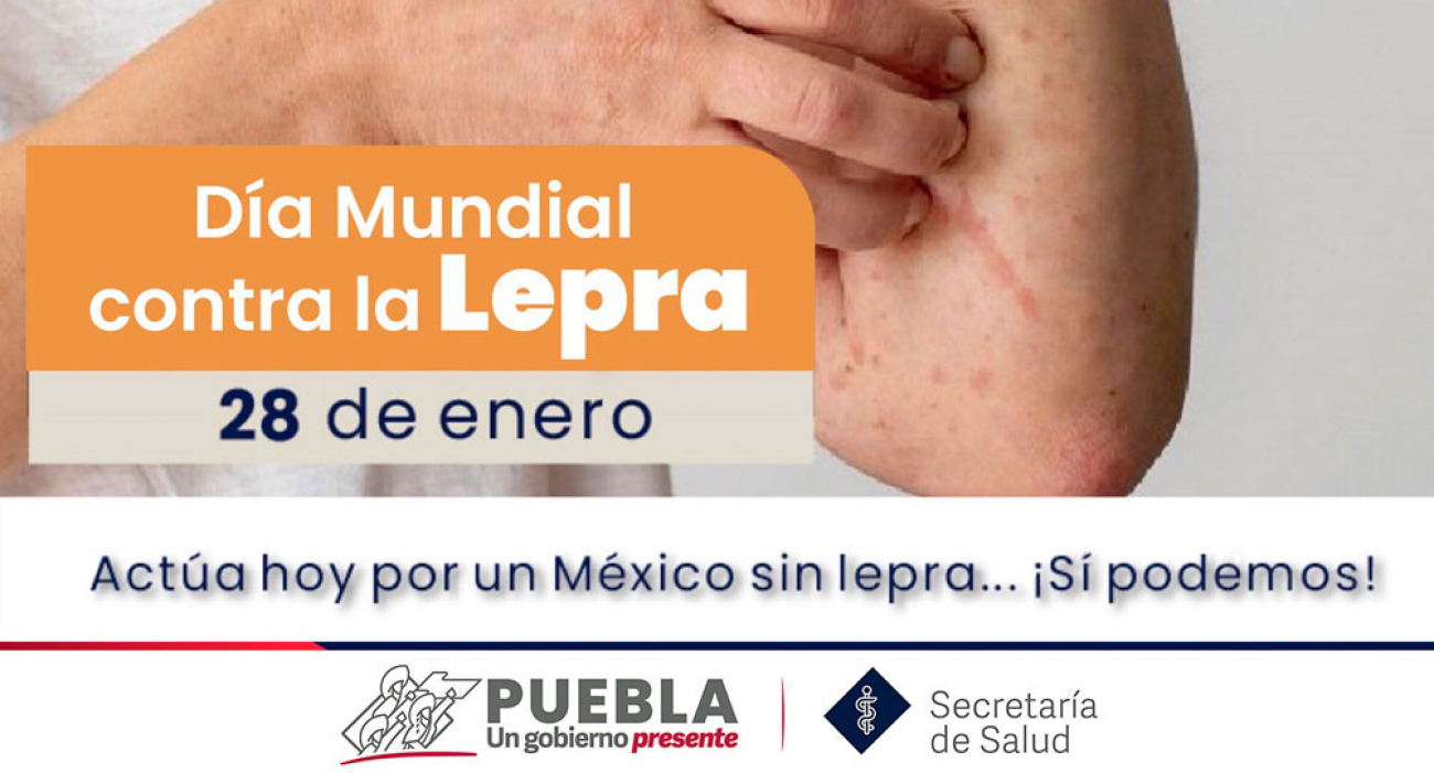 Día Mundial contra la lepra
